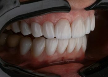 a person's mouth with teeth