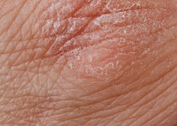 Detailed image highlighting dry, flaky skin texture for dermatological study.