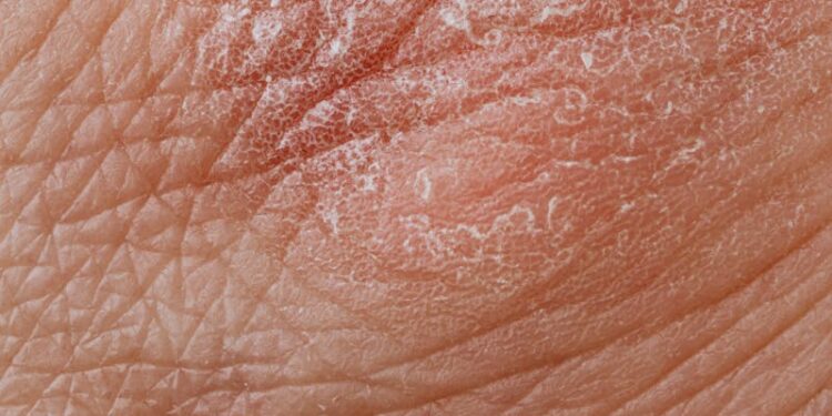 Detailed image highlighting dry, flaky skin texture for dermatological study.