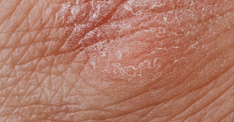 Graisse abdominale et psoriasis