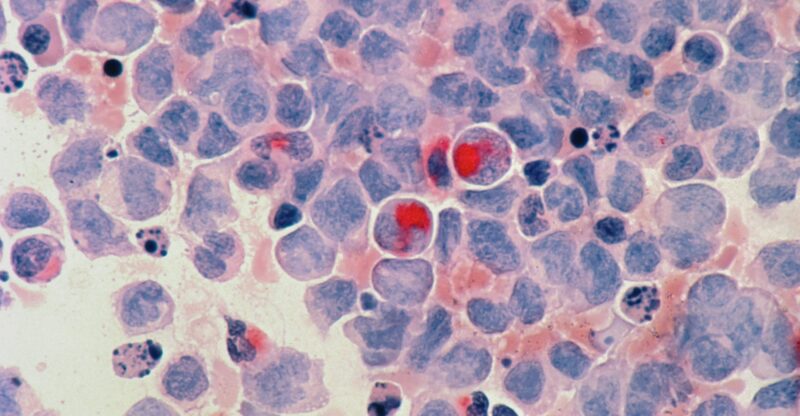 Les mastocytes : sentinelles immunitaires et acteurs méconnus de l’inflammation chronique