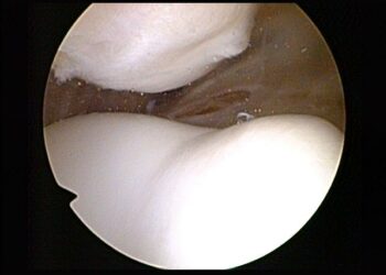 Glucosamine et cartilage : rôle structural et implications anti-inflammatoires systémiques