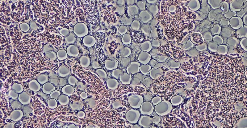 Déficit en ribose cellulaire