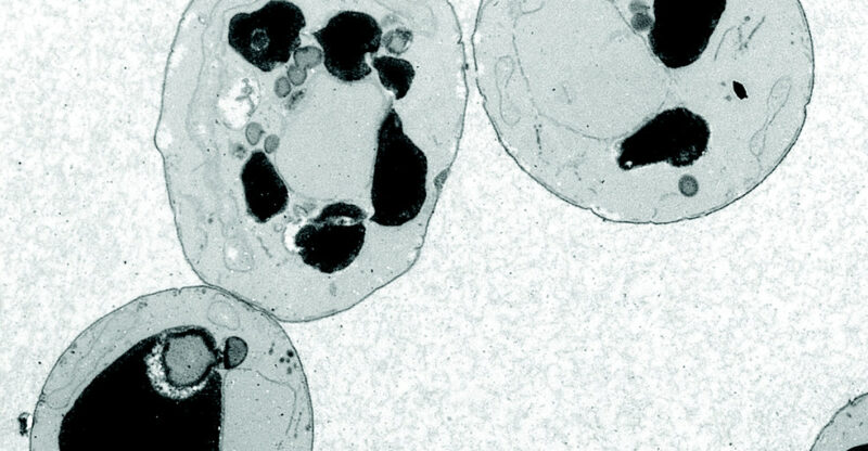 Dysfonction du métabolisme des sphingomyélines